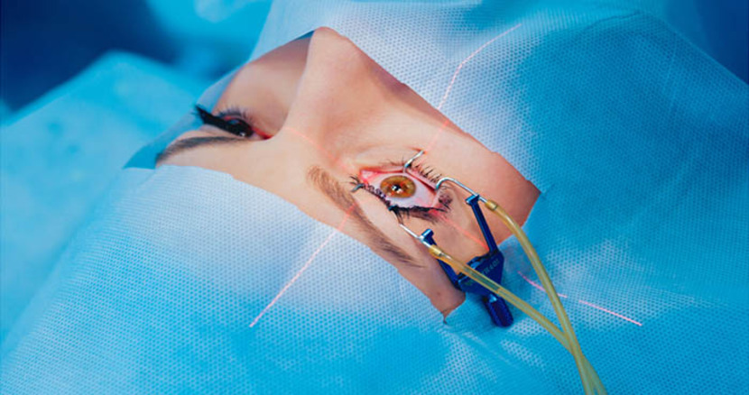 لیزیک (LASIK)