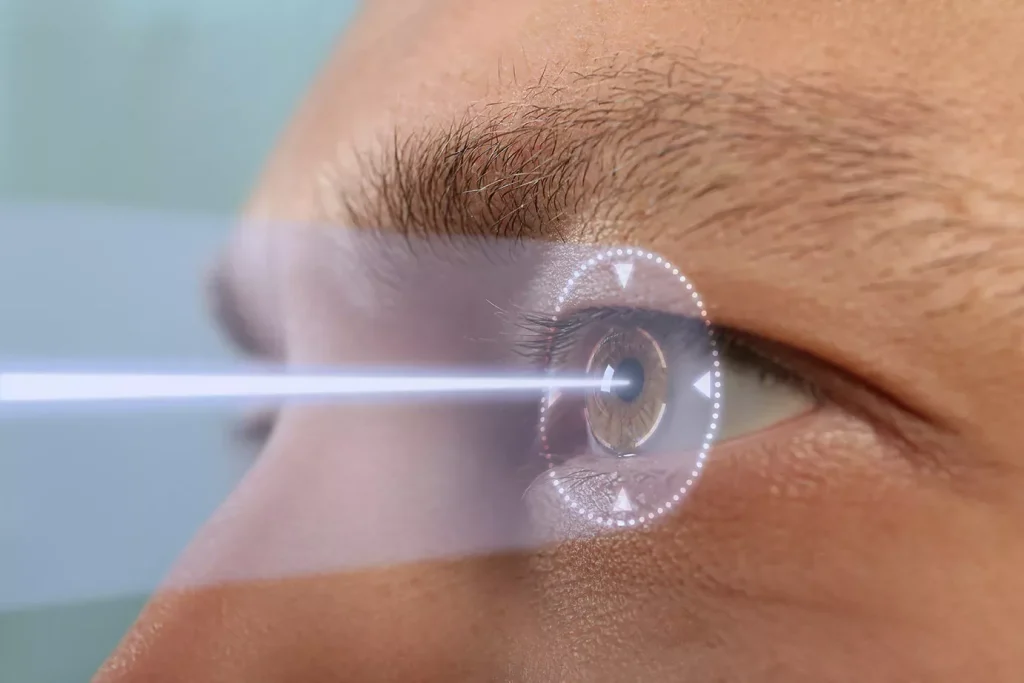 Preparing for LASIK Surgery 4