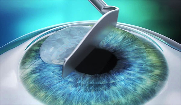 LASIK-02
